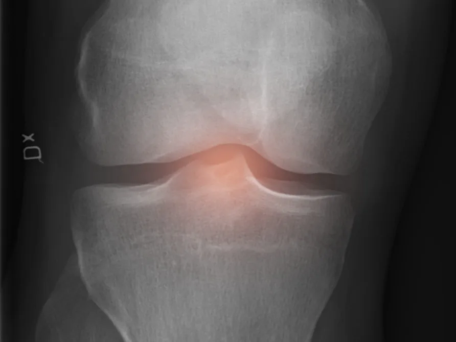 Knee radiograph with the joint line highlighted, where knee pain commonly localises