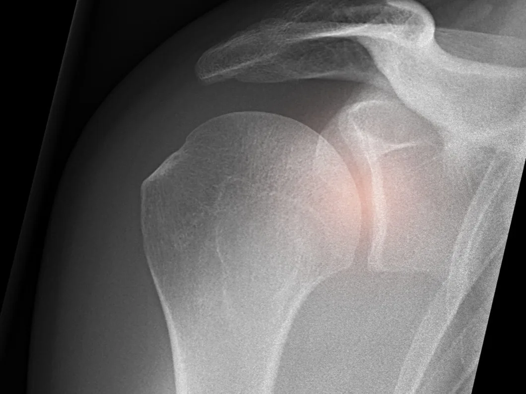 Shoulder radiograph with the glenohumeral joint highlighted, where shoulder pain commonly localises