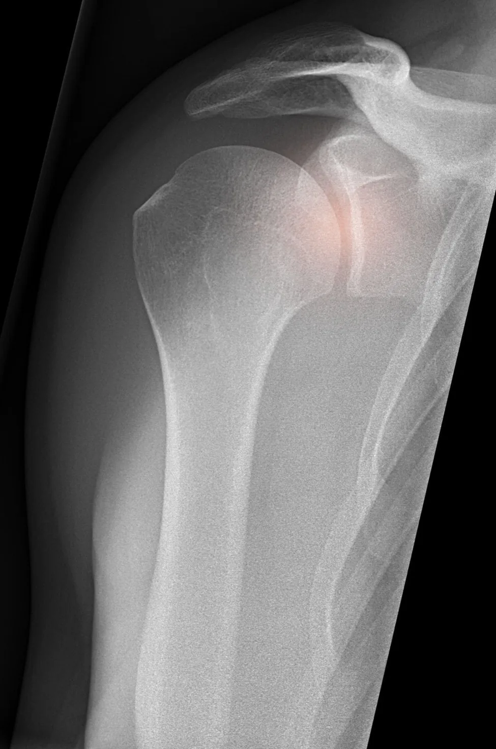 Radiograph of a shoulder showing the glenohumeral joint highlighted, where shoulder pain commonly localises