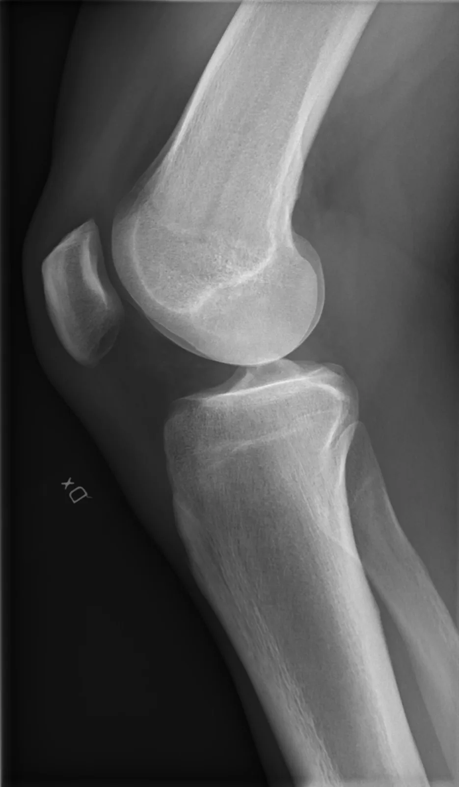 Knee radiograph, lateral view