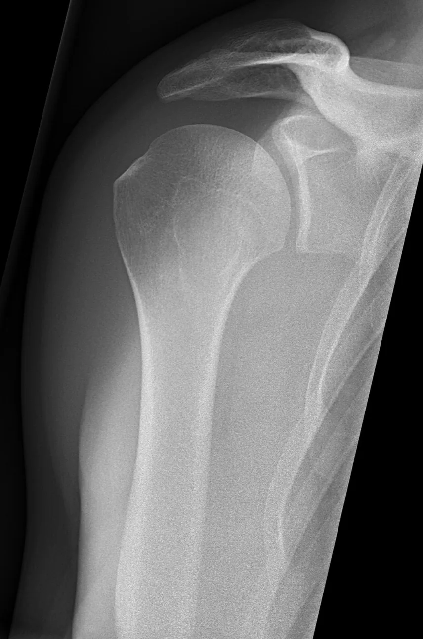 Shoulder radiograph, anteroposterior view
